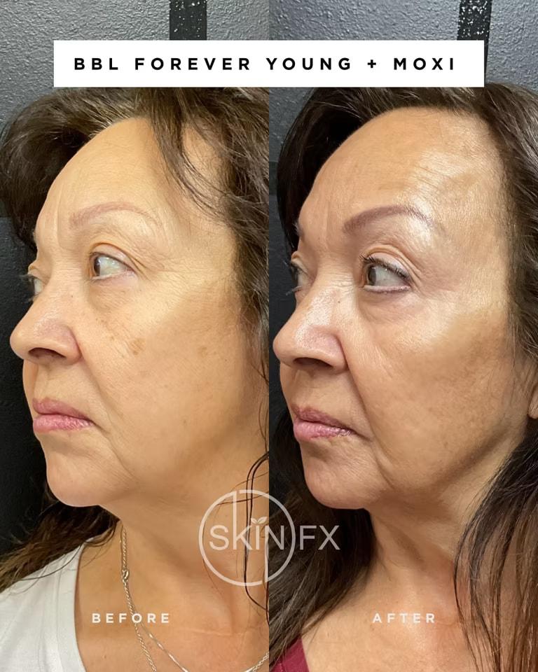 SkinFX Med Spa photofacial result — Clinton, UT
