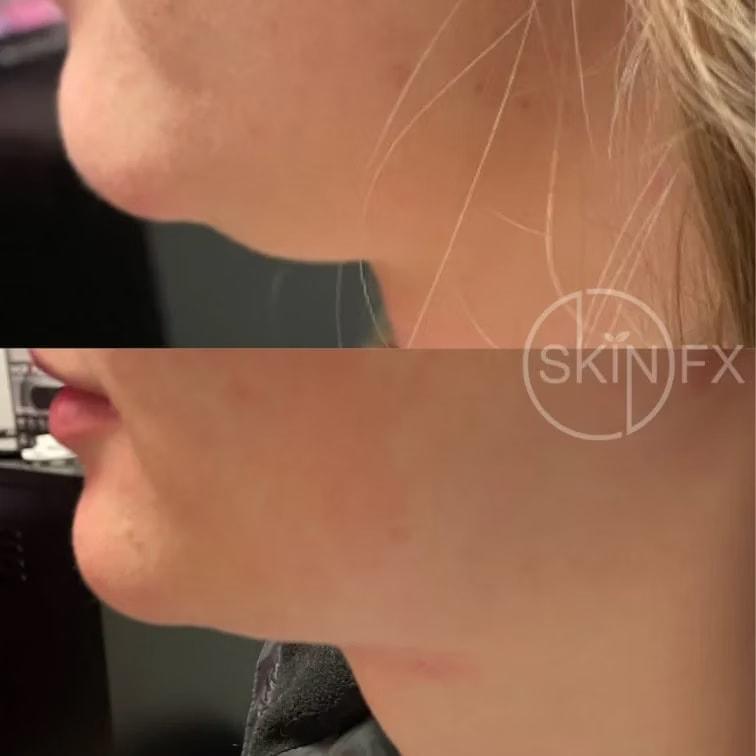 SkinFX Med Spa jawline filler result — Clinton, UT
