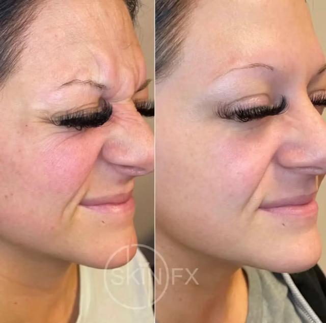 Botox result at SkinFX Med Spa in Clinton, UT