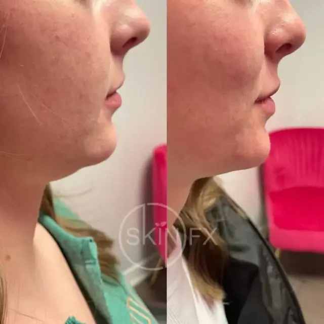 Jawline Filler result at SkinFX Med Spa in Clinton, UT