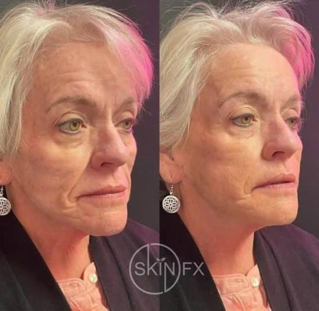 Jawline Filler result at SkinFX Med Spa in Clinton, UT