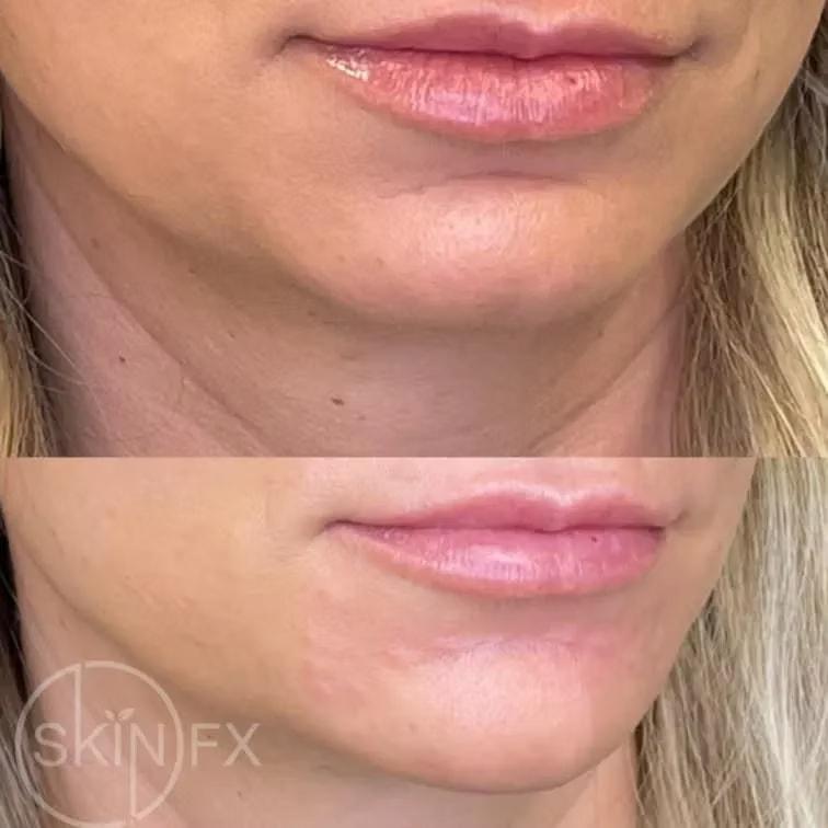 SkinFX Med Spa jawline filler result — Clinton, UT