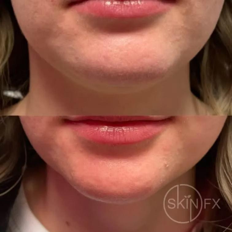SkinFX Med Spa jawline filler result — Clinton, UT