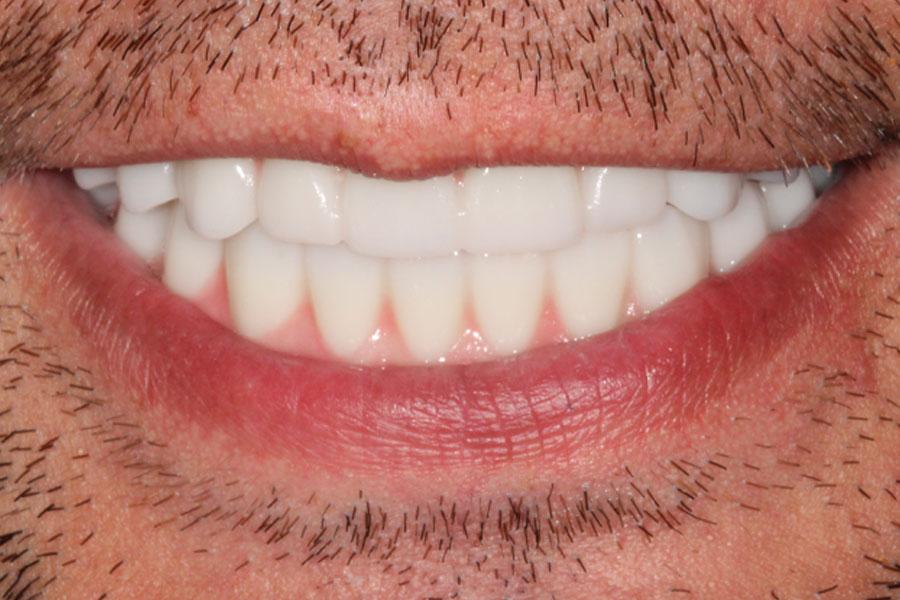 Enamel General & Cosmetic Dentistry smile makeover after — Newport Beach, CA