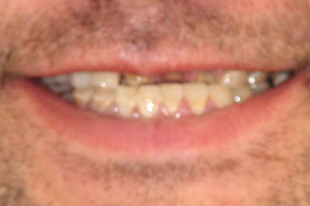 Smile Makeover before at Enamel General & Cosmetic Dentistry in Newport Beach, CA