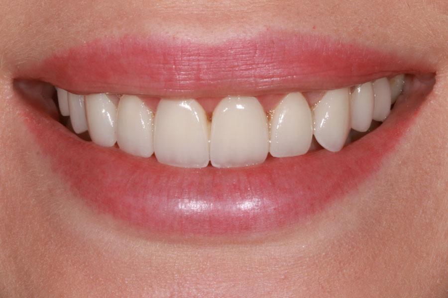 Enamel General & Cosmetic Dentistry smile makeover after — Newport Beach, CA