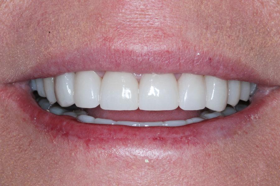 Enamel General & Cosmetic Dentistry smile makeover after — Newport Beach, CA