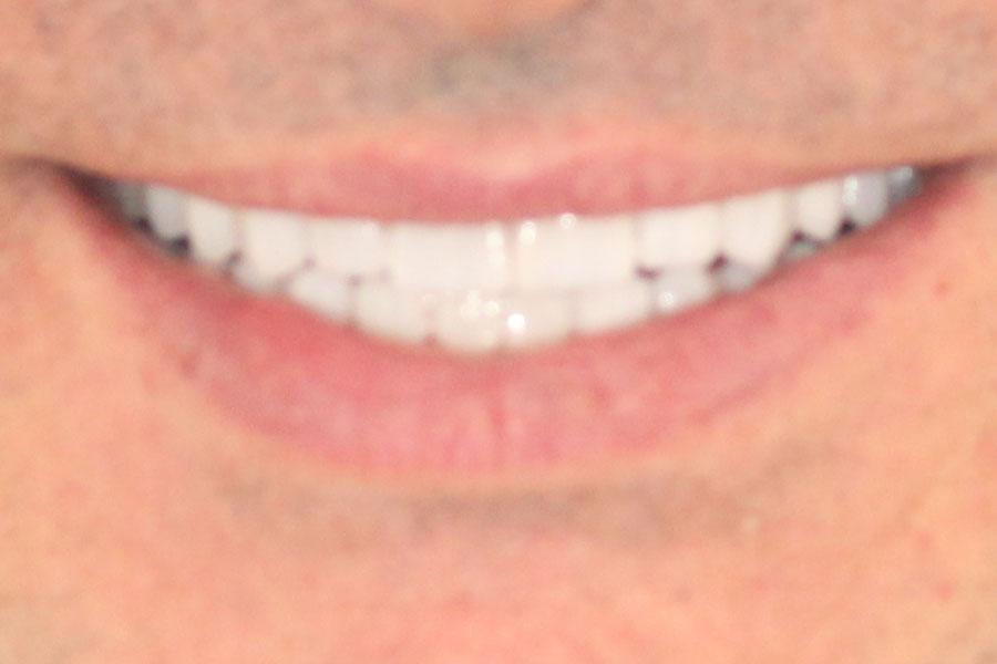 Enamel General & Cosmetic Dentistry smile makeover after — Newport Beach, CA