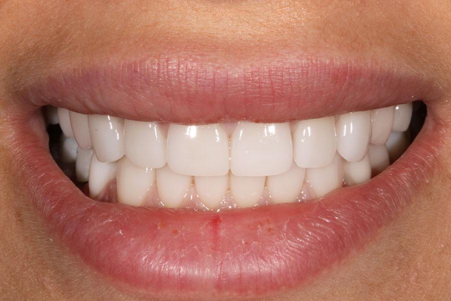 Enamel General & Cosmetic Dentistry smile makeover after — Newport Beach, CA