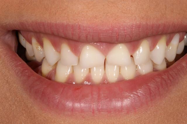 Smile Makeover before at Enamel General & Cosmetic Dentistry in Newport Beach, CA