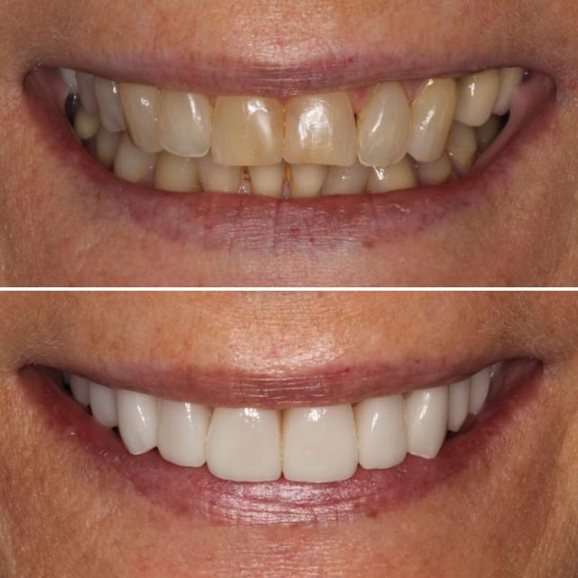 Dental Veneers result at Chase Inspired Dentistry in Draper, UT