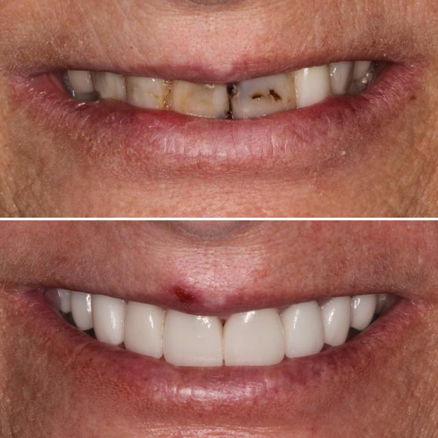 Dental Crowns result at Chase Inspired Dentistry in Draper, UT