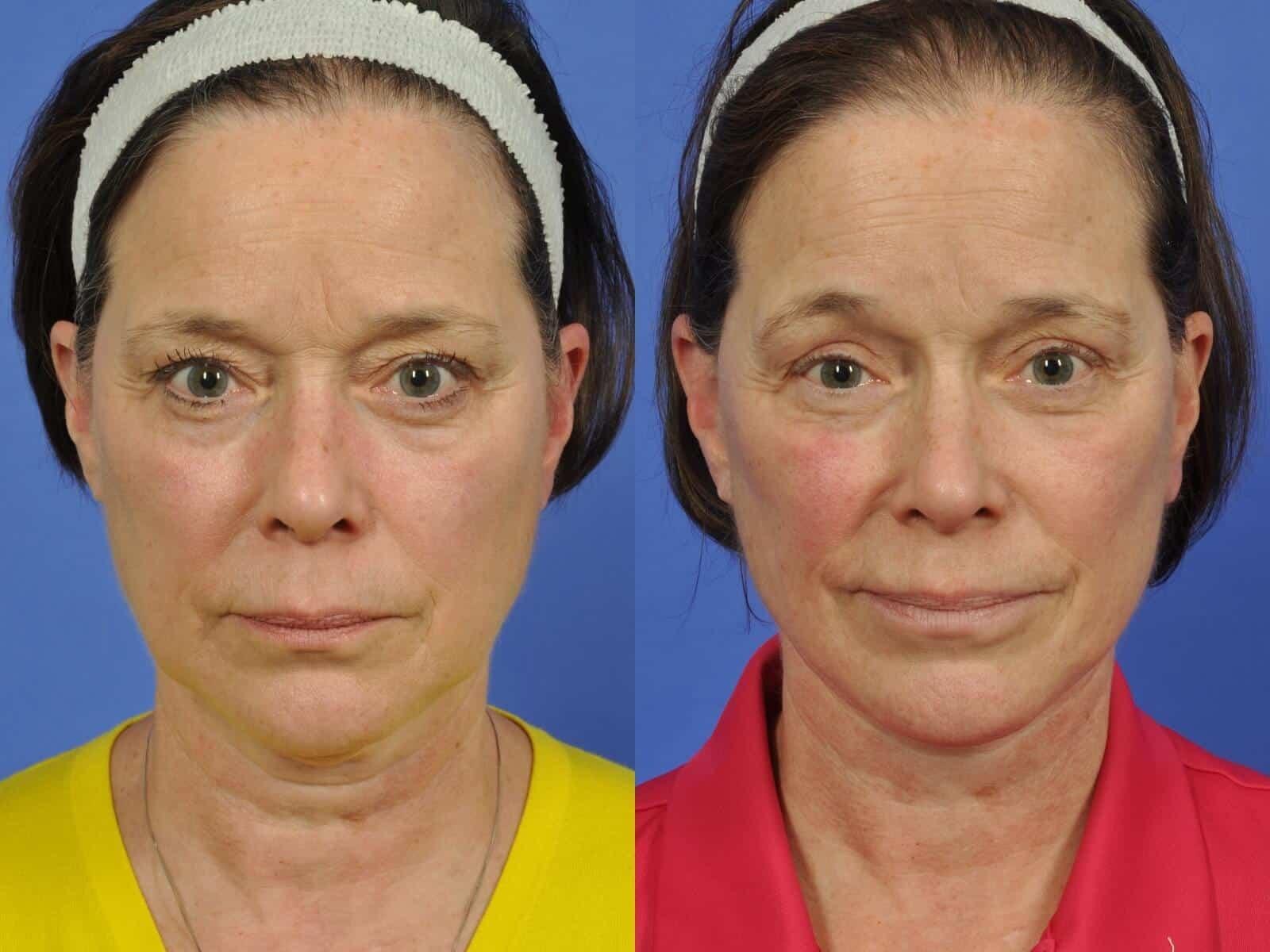 W Cosmetic Surgery neck lift result — Plymouth Meeting, PA