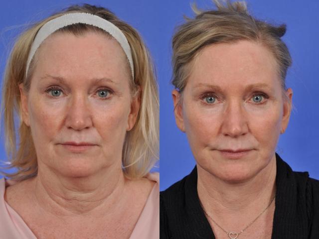 Deep Plane Facelift result at W Cosmetic Surgery in Plymouth Meeting, PA