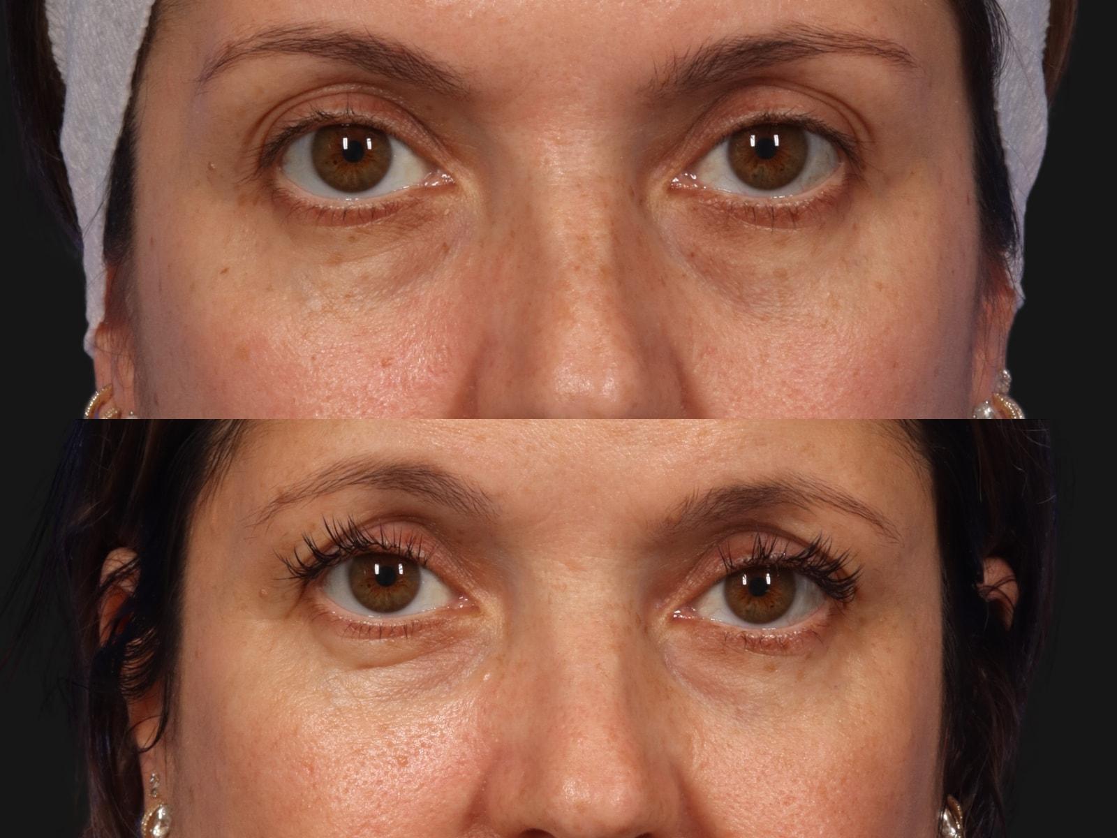 W Cosmetic Surgery photofacial result — Plymouth Meeting, PA