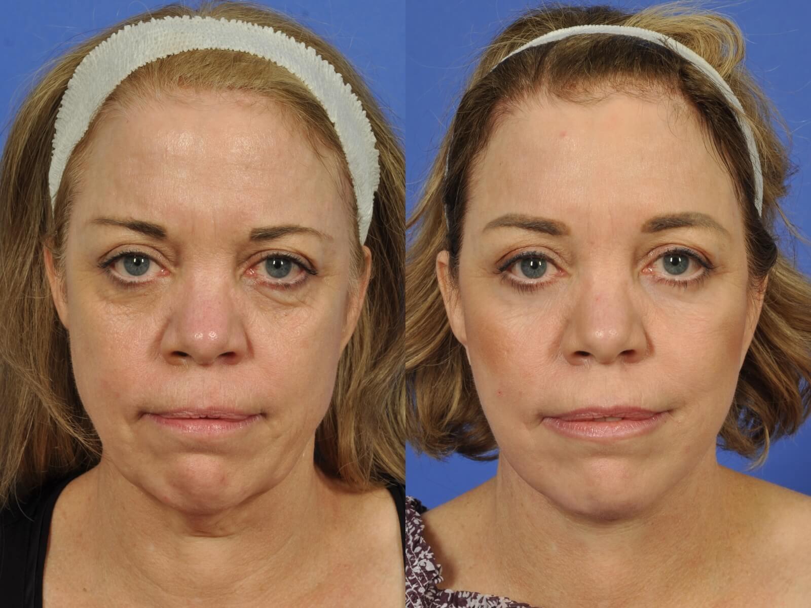 W Cosmetic Surgery neck lift result — Plymouth Meeting, PA