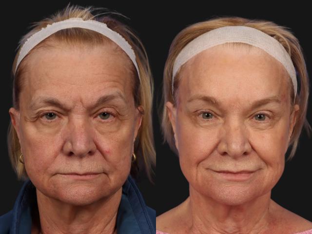 Blepharoplasty result at W Cosmetic Surgery in Plymouth Meeting, PA