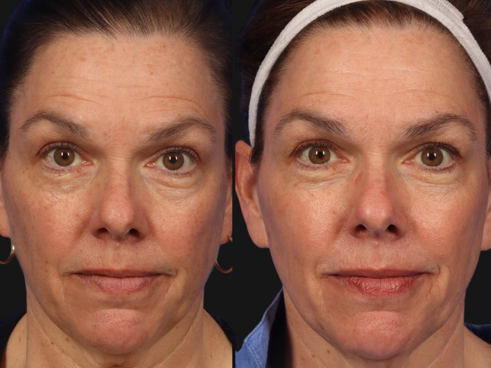 W Cosmetic Surgery photofacial result — Plymouth Meeting, PA