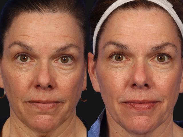 Microneedling result at W Cosmetic Surgery in Plymouth Meeting, PA