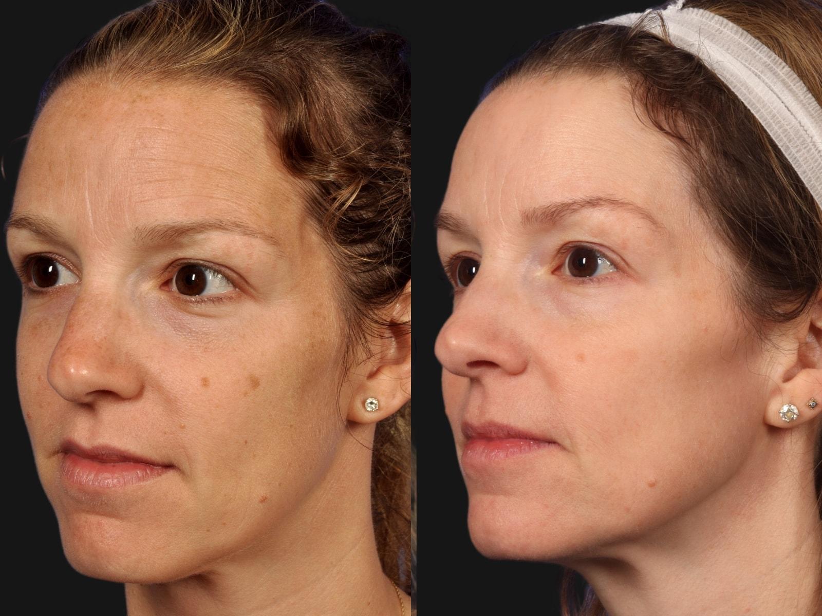 W Cosmetic Surgery photofacial result — Plymouth Meeting, PA