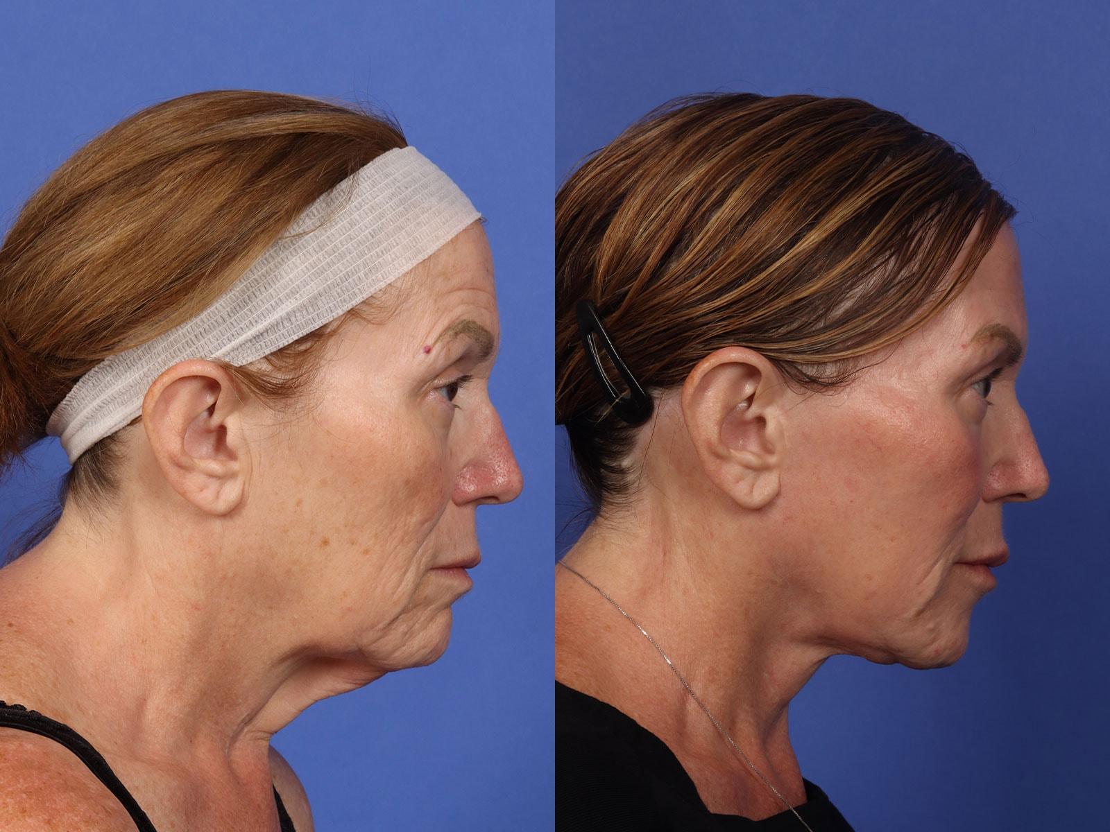 W Cosmetic Surgery neck lift result — Plymouth Meeting, PA