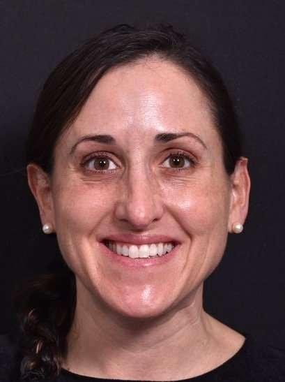 Aviva Plastic Surgery & Aesthetics botox after — Atlanta, GA