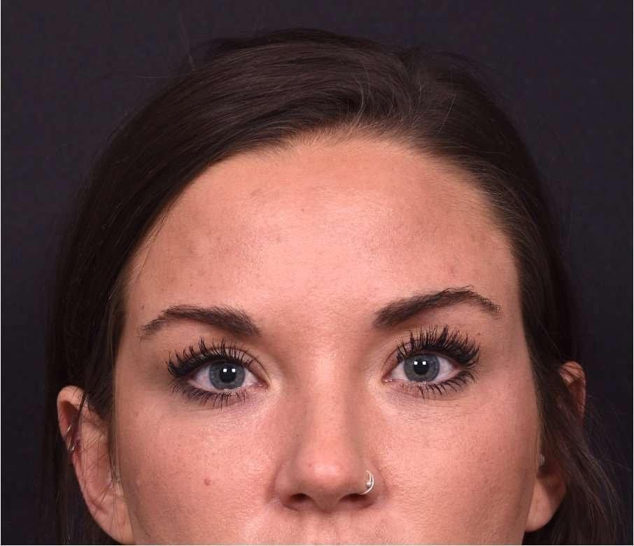Aviva Plastic Surgery & Aesthetics botox after — Atlanta, GA