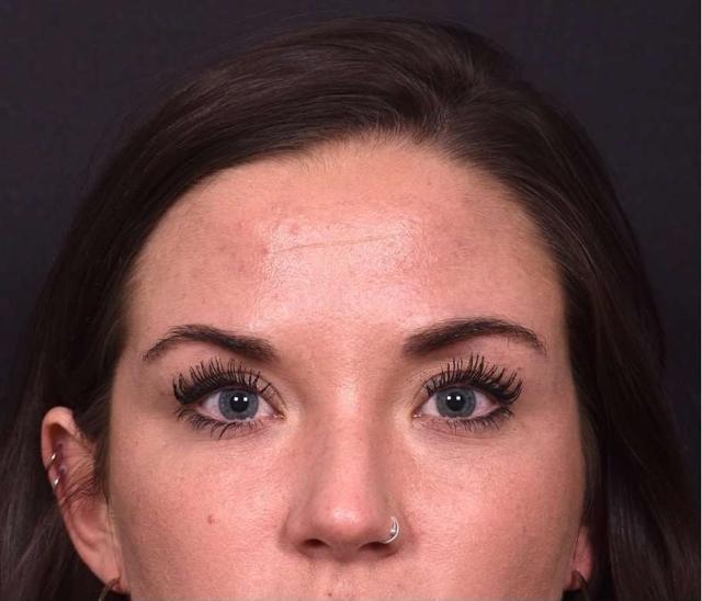 Botox before at Aviva Plastic Surgery & Aesthetics in Atlanta, GA