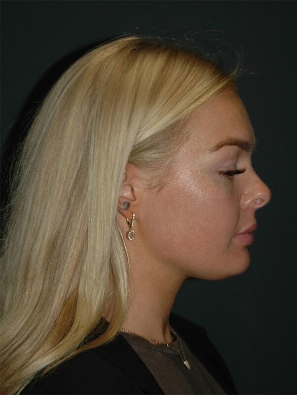 Lip Filler before at Malone Facial Plastic Surgery in San Diego, CA