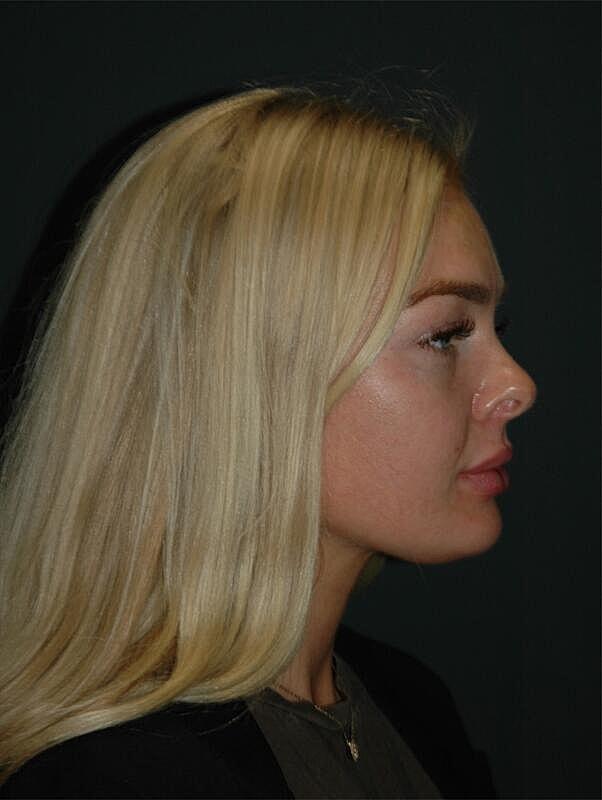 Lip Filler after at Malone Facial Plastic Surgery in San Diego, CA