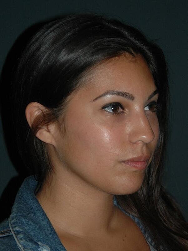 Lip Filler before at Malone Facial Plastic Surgery in San Diego, CA