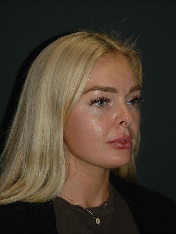 Lip Filler after at Malone Facial Plastic Surgery in San Diego, CA
