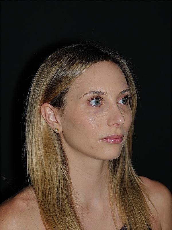 Functional Rhinoplasty after at Malone Facial Plastic Surgery in San Diego, CA