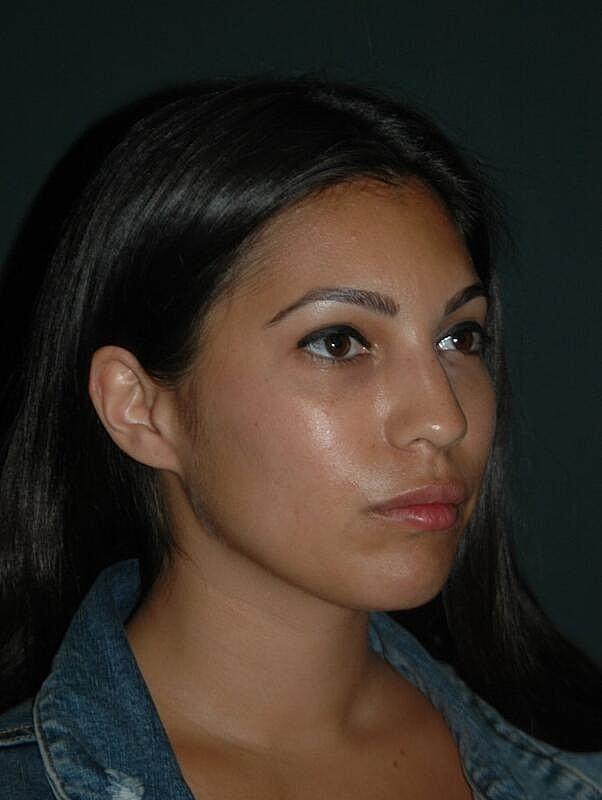 Lip Filler after at Malone Facial Plastic Surgery in San Diego, CA
