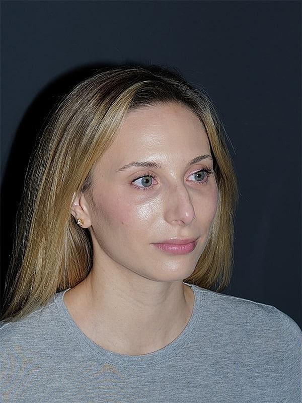 Functional Rhinoplasty before at Malone Facial Plastic Surgery in San Diego, CA