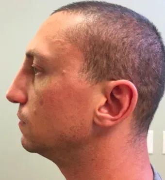 Visage Surgical (David Folk, MD) rhinoplasty after — Paramus, NJ