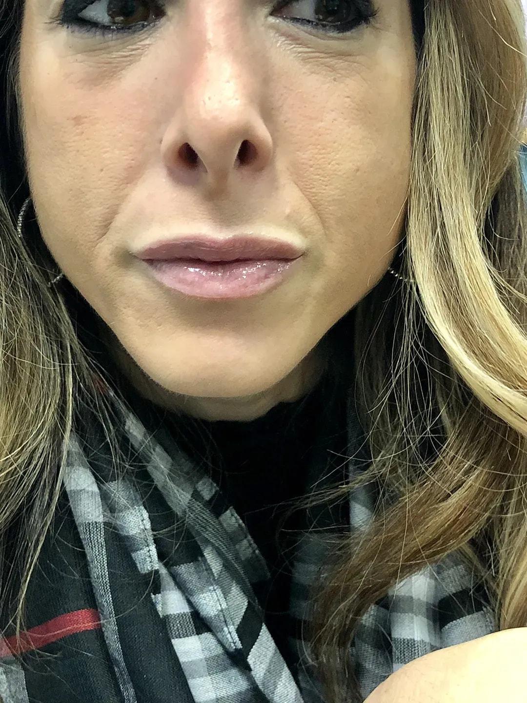 Visage Surgical (David Folk, MD) lip filler after — Paramus, NJ