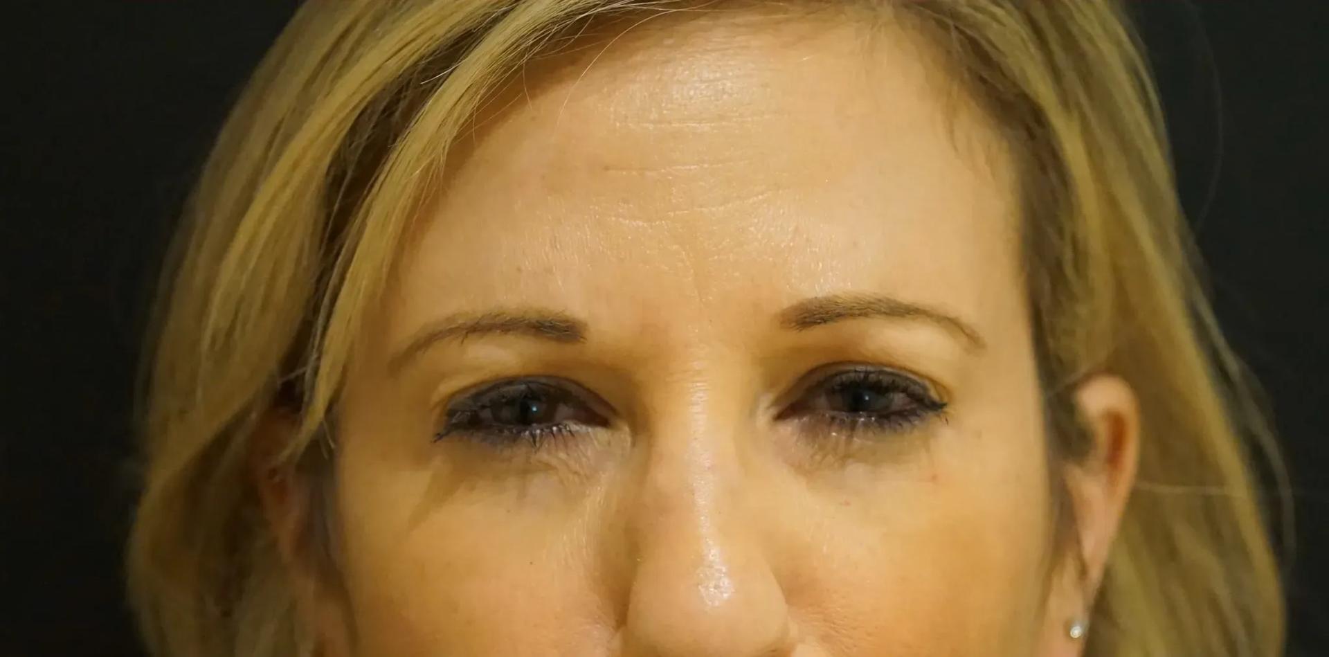 Visage Surgical (David Folk, MD) botox after — Paramus, NJ