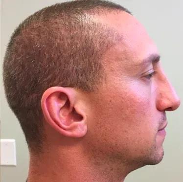 Visage Surgical (David Folk, MD) rhinoplasty after — Paramus, NJ