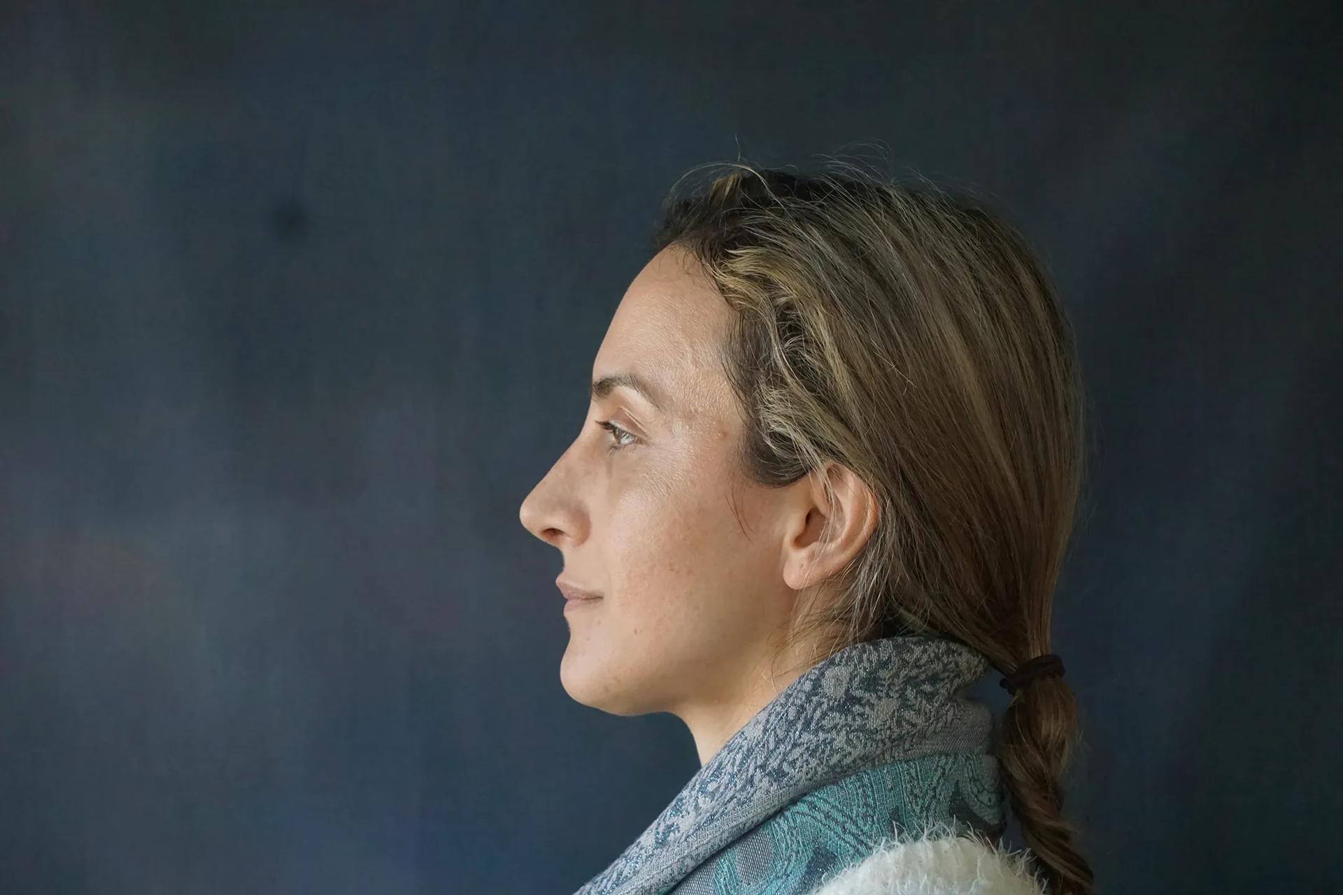 Visage Surgical (David Folk, MD) rhinoplasty after — Paramus, NJ