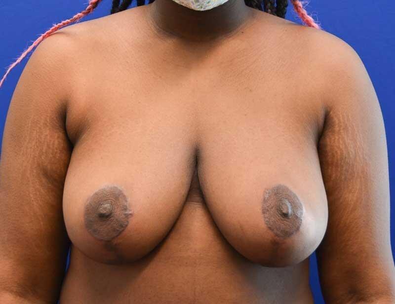 Mirzabeigi Atlanta Plastic Surgery breast reduction after — Atlanta, GA