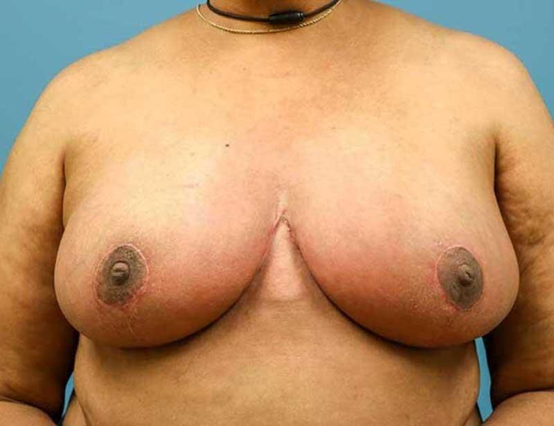 Mirzabeigi Atlanta Plastic Surgery breast reduction after — Atlanta, GA