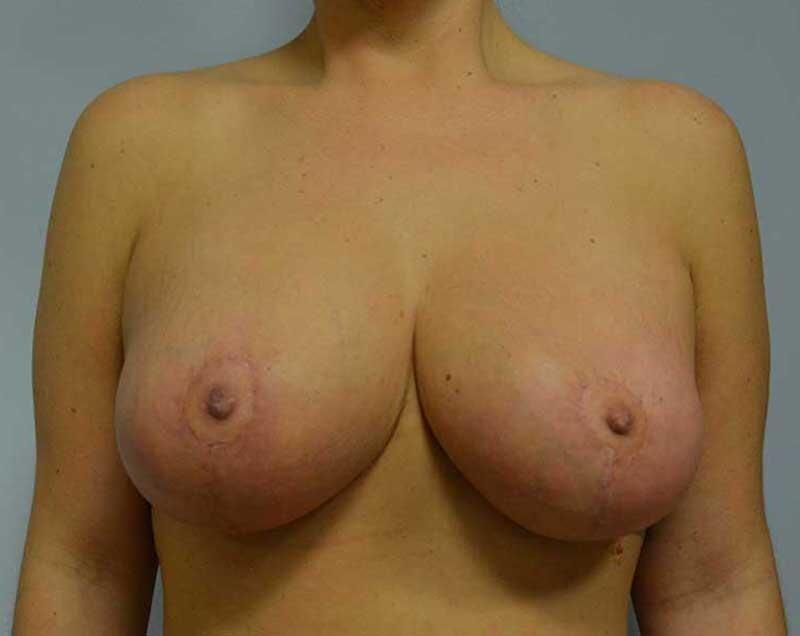 Mirzabeigi Atlanta Plastic Surgery breast augmentation revision after — Atlanta, GA