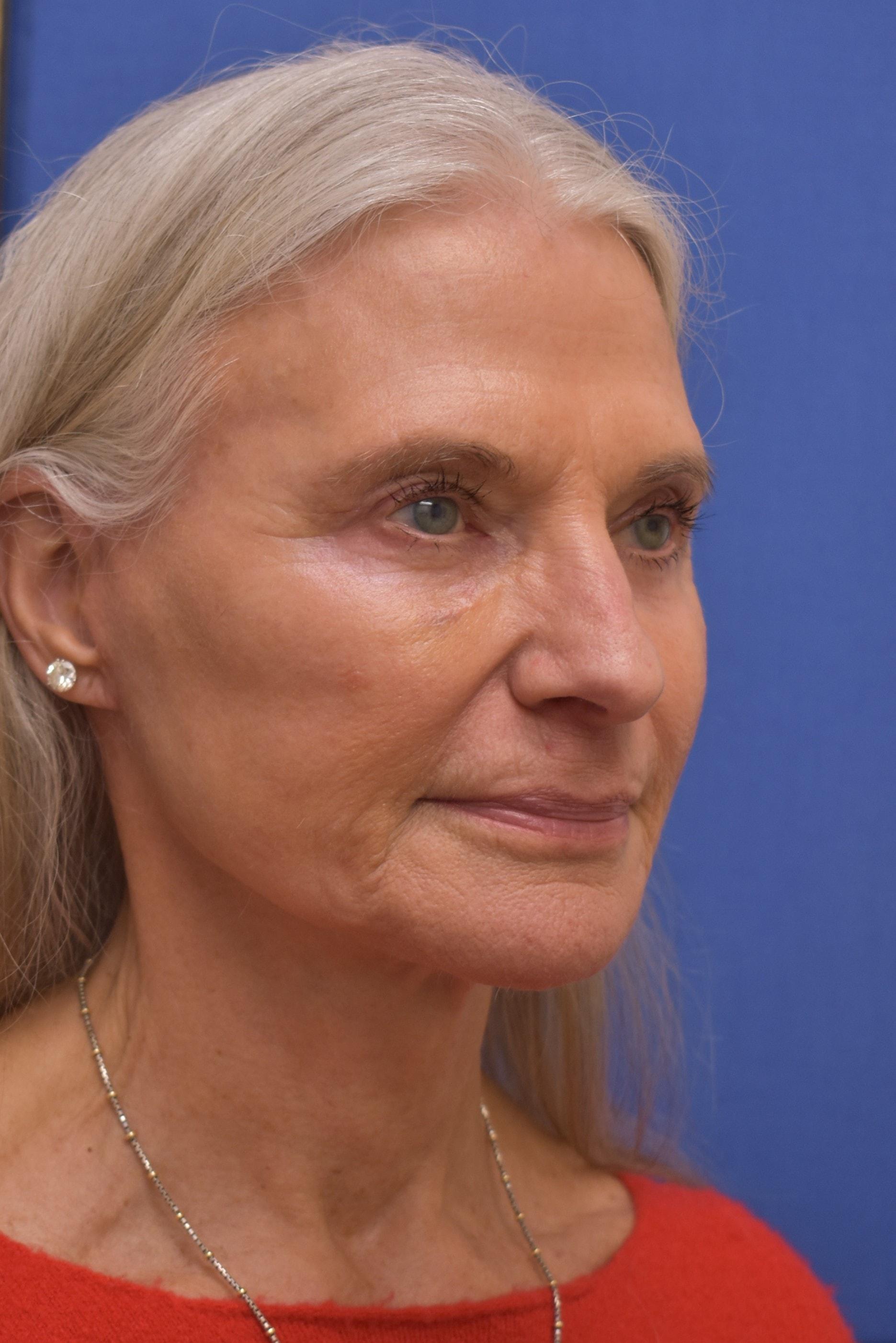 Liebertz Plastic Surgery at Yarrow Bay facelift after — Kirkland, WA
