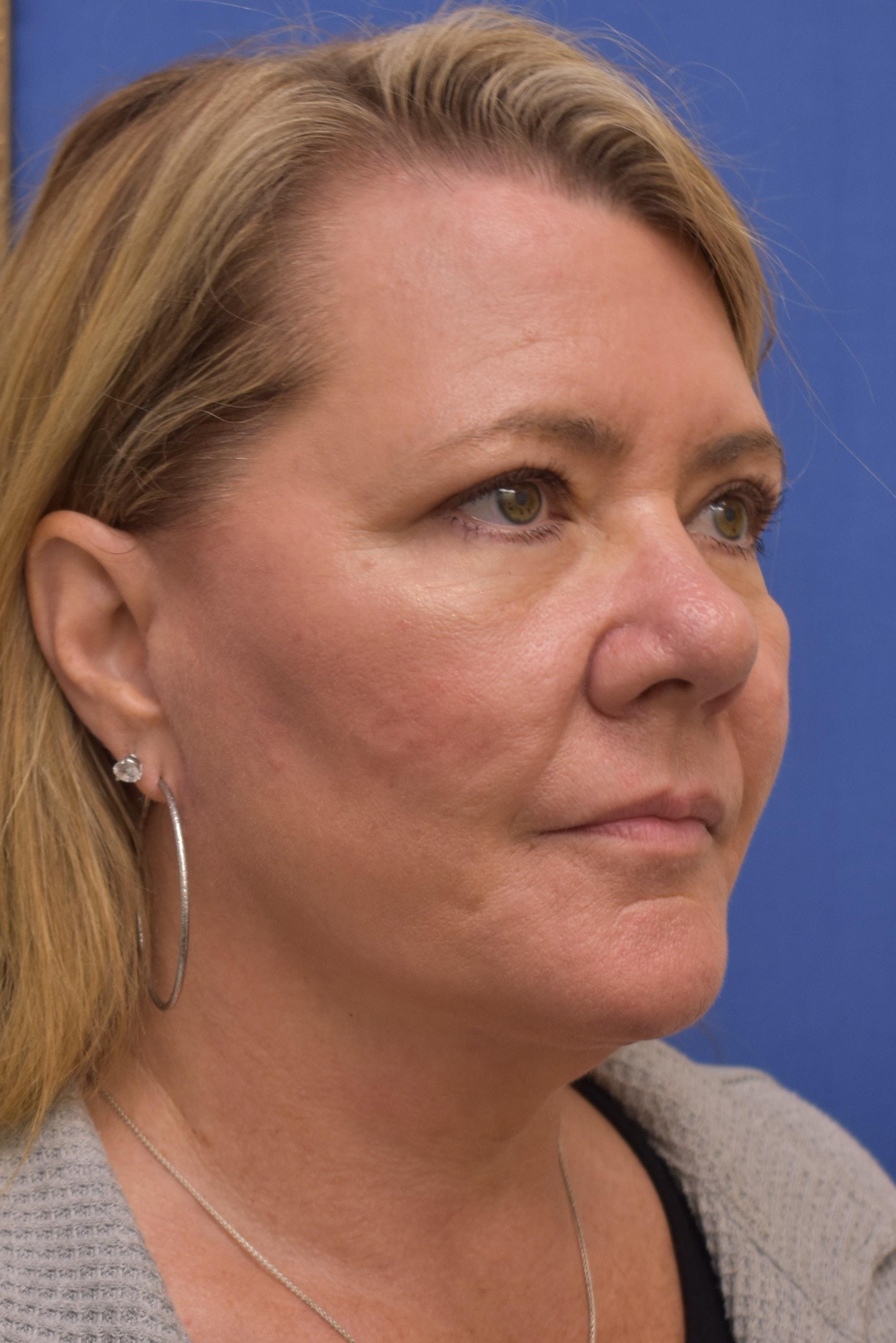 Liebertz Plastic Surgery at Yarrow Bay facelift after — Kirkland, WA