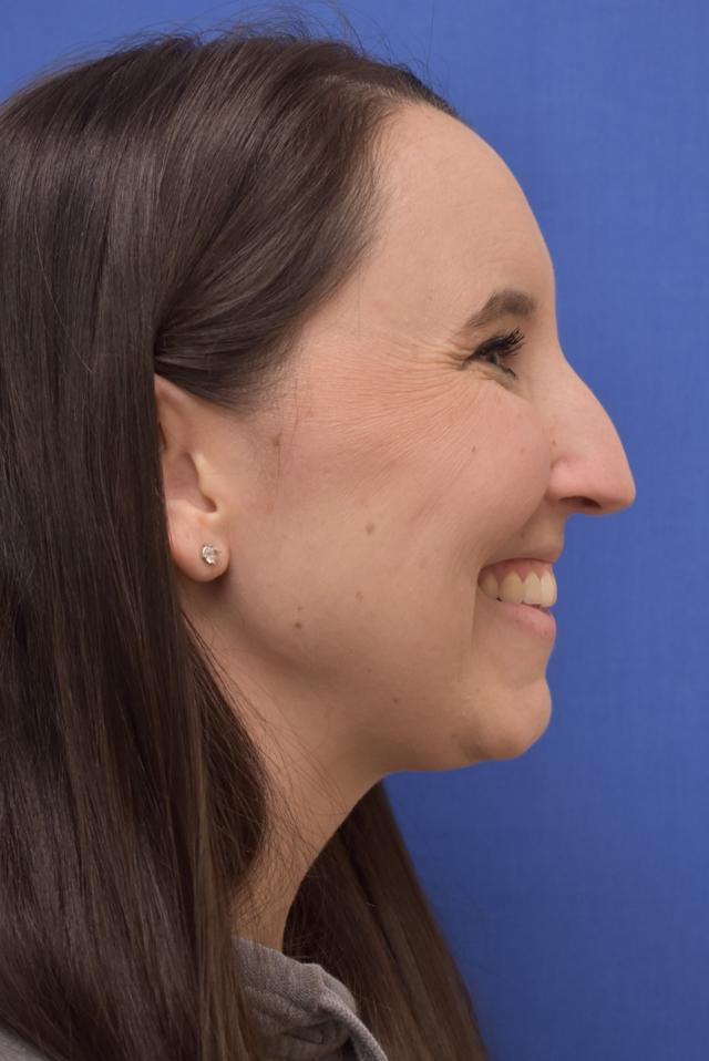 Rhinoplasty before at Liebertz Plastic Surgery at Yarrow Bay in Kirkland, WA
