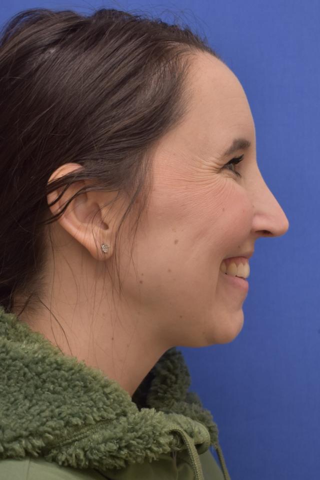 Rhinoplasty after at Liebertz Plastic Surgery at Yarrow Bay in Kirkland, WA