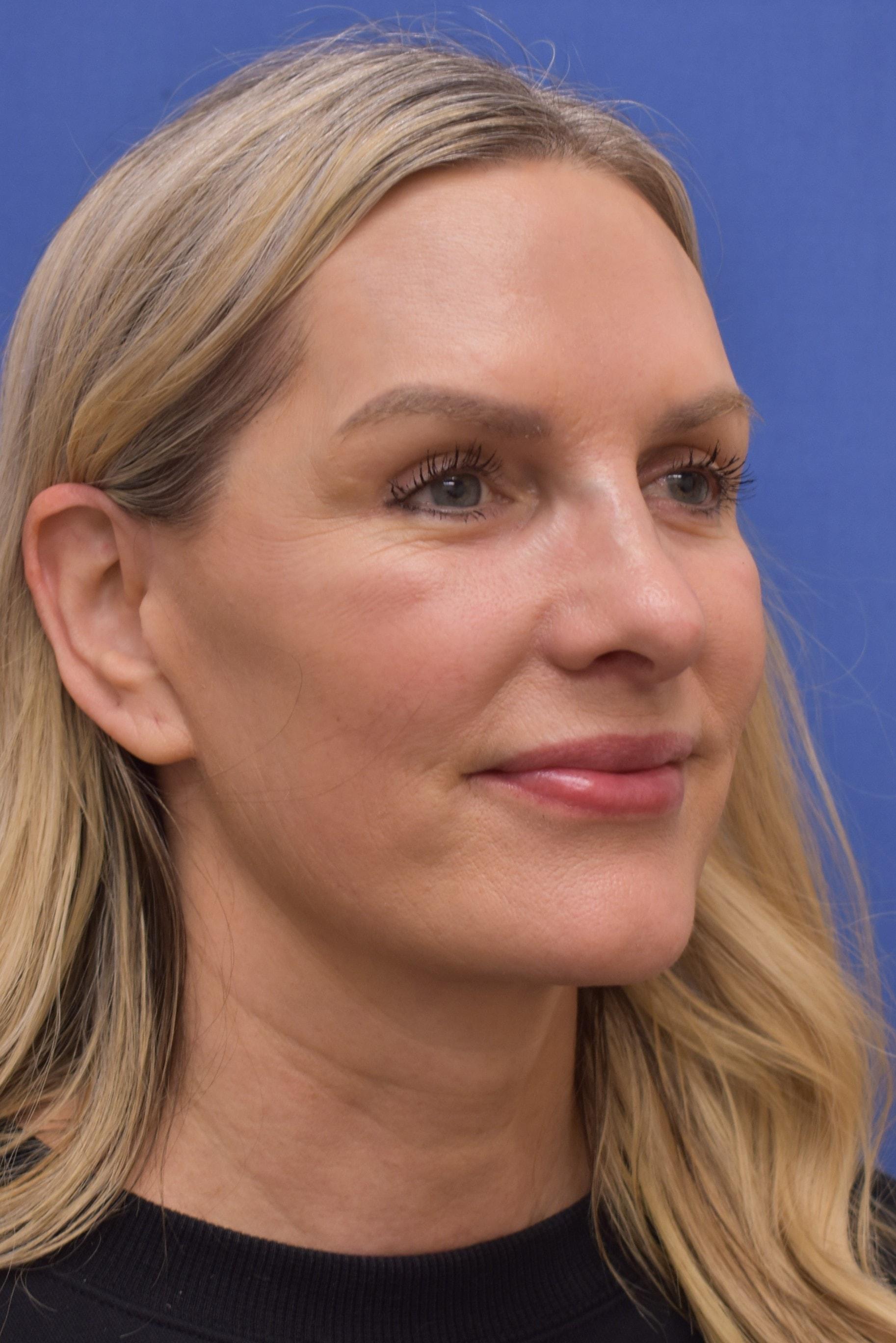 Liebertz Plastic Surgery at Yarrow Bay facelift after — Kirkland, WA