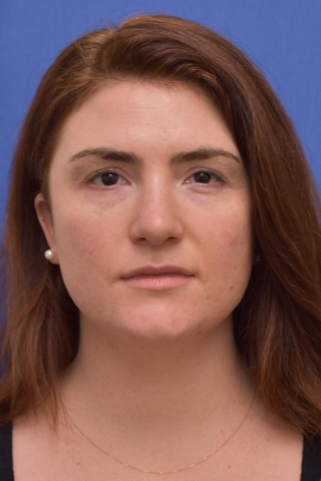 Neck Liposuction before at Liebertz Plastic Surgery at Yarrow Bay in Kirkland, WA