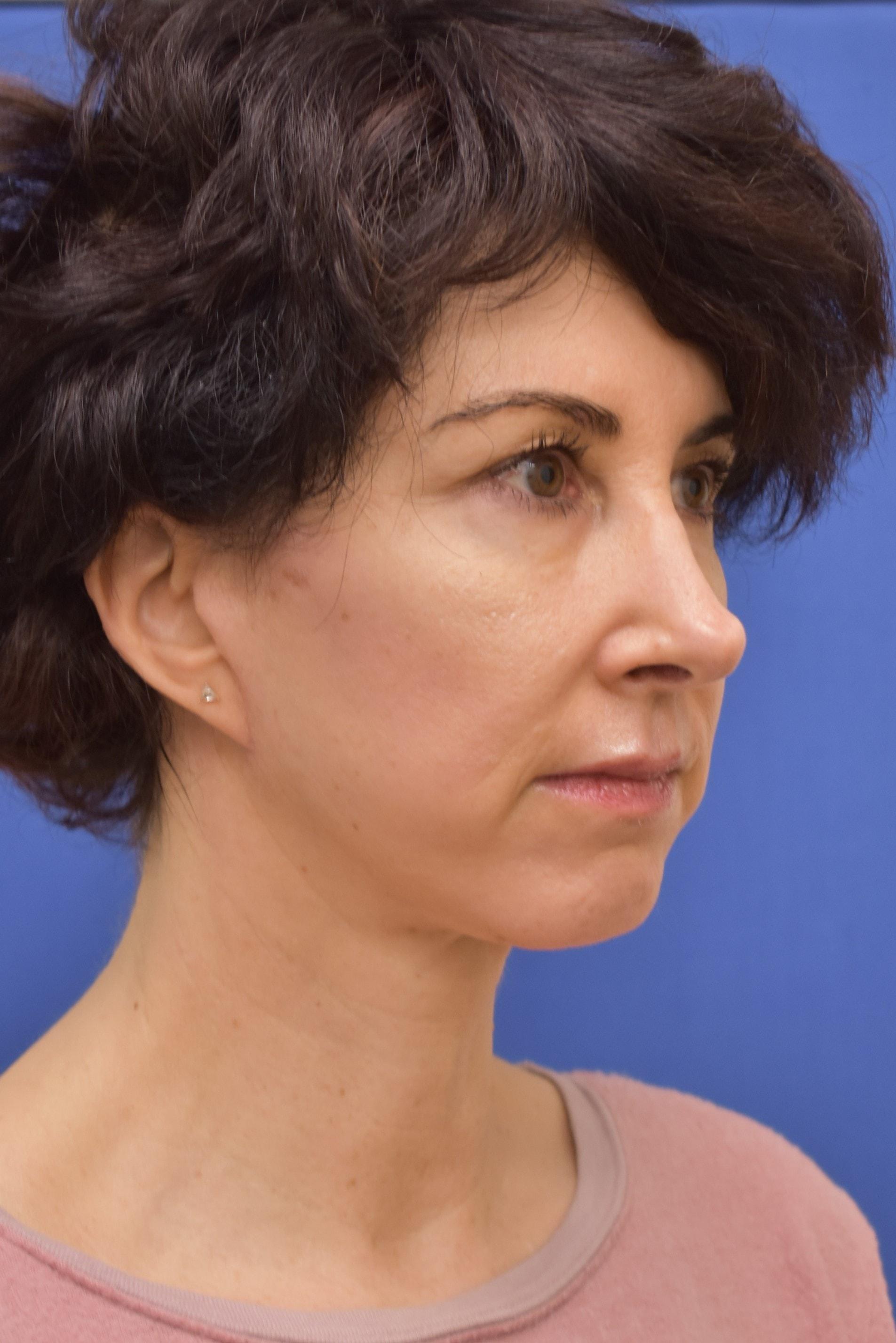 Liebertz Plastic Surgery at Yarrow Bay facelift after — Kirkland, WA